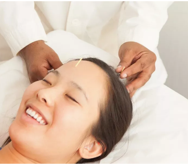 Smiling woman getting acupuncture